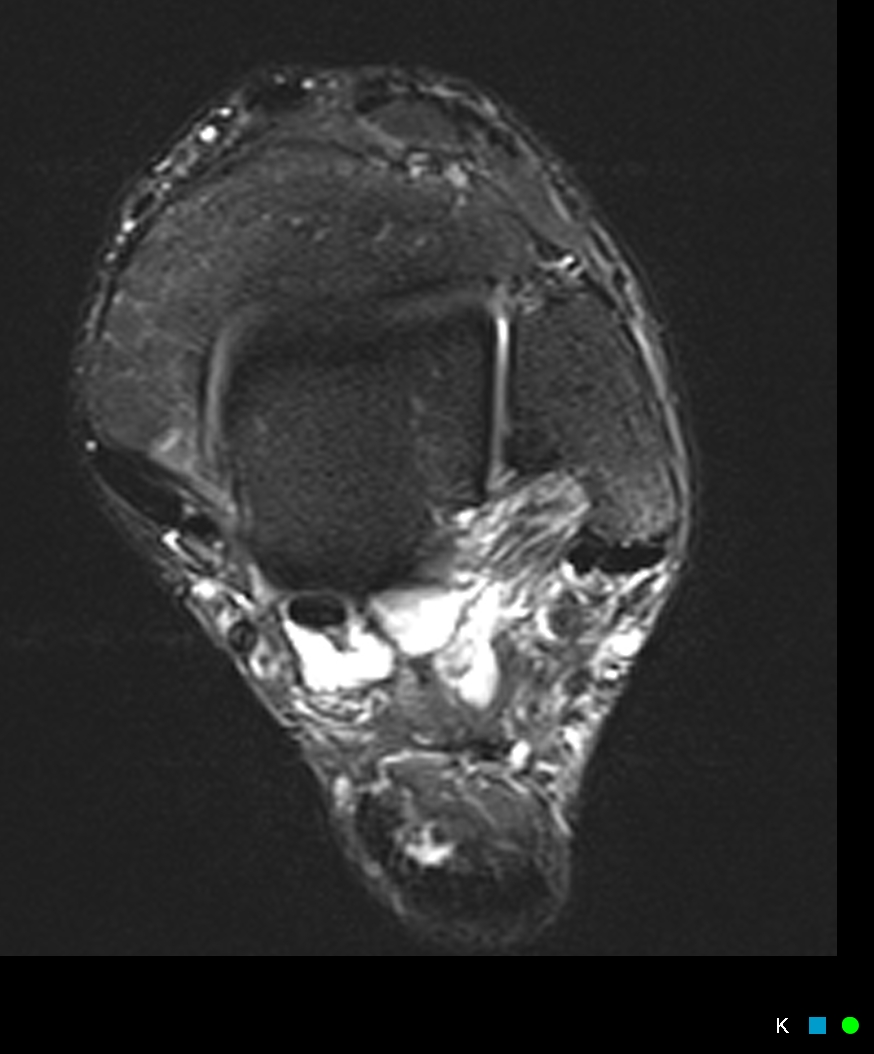Figure 3 for case SPR tear proximal to fibular insertion